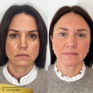 Results of Nonsurgical facelift