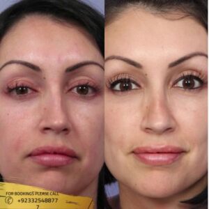 septoplasty surgery before and after