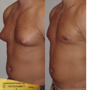 gynecomastia surgery before and after