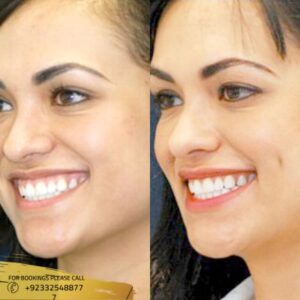 dimple creation cost in Islamabad