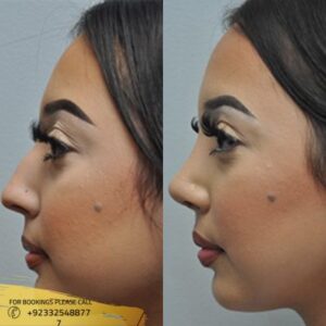 Nose Tip Plasty before and after