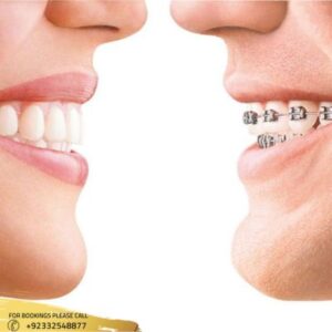 Results of Dental Braces