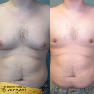 Results of gynecomastia surgery