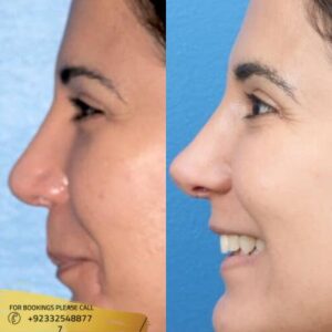 Nose Tip Plasty cost in Islamabad