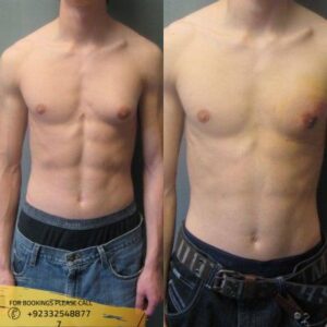 gynecomastia surgery cost in Islamabad