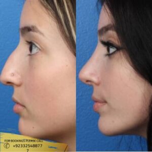 Results of Nose Tip Plasty