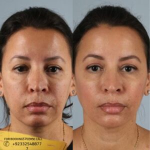 Botox injections before and after