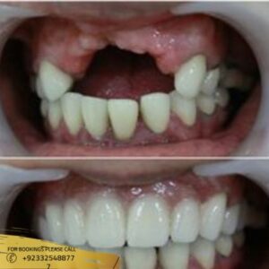 Zirconia Crown before and after