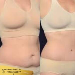 Abdominoplasty before and after