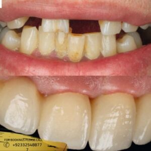 Results of Zirconia Crown