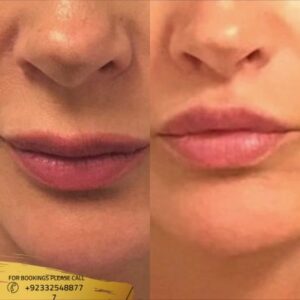 Lip Reduction cost in Islamabad