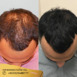 cost of PRP hair treatment in Pakistan