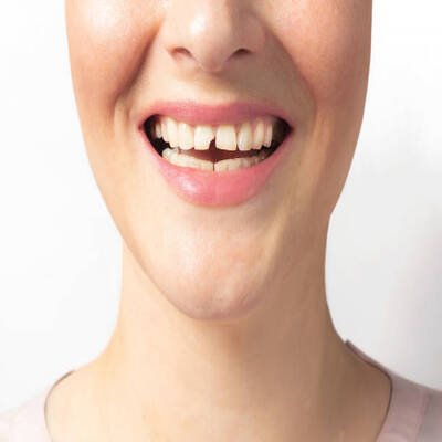 Fracture Teeth Treatment Pros Cons of Fracture Teeth Treatment