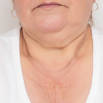 Does liposuction work on the neck?