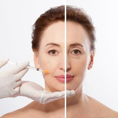 Top 5 Ways Dermal Fillers Can Improve Your Skin