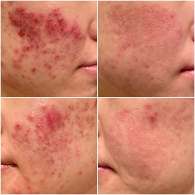 What’s the difference between acne marks and acne scars?