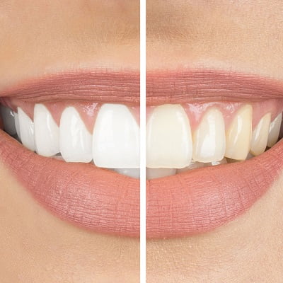 5 ways to keep your teeth white after laser whitening