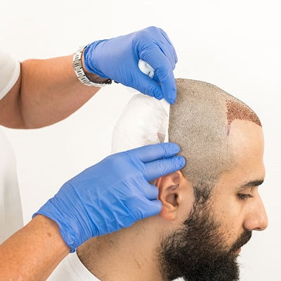 Who is the reliable clinic to trust for your hair transplant surgery?