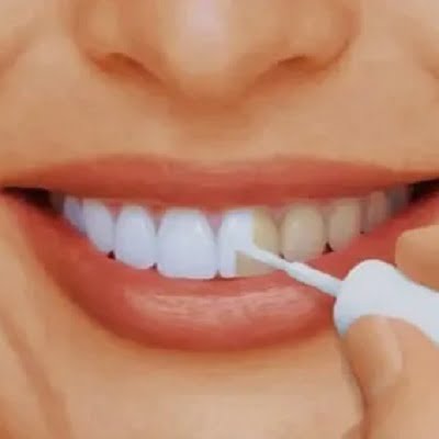 5 Signs That Your Teeth May Need Whitening in Islamabad