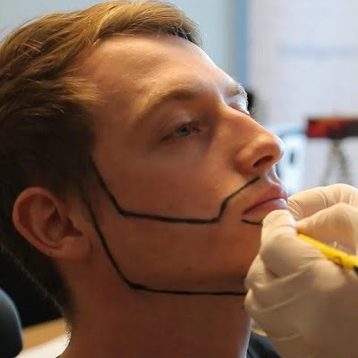 How many grafts are used for full beard hair transplant in Islamabad