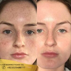 chemical skin peel results