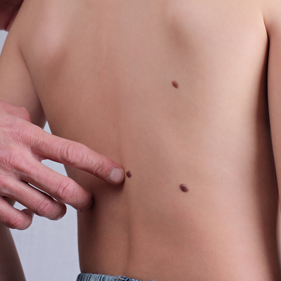 How Much Does Skin Tag Removal Cost in Islamabad?