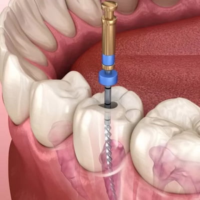 3 Stages of Root Canal Treatment