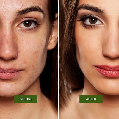 Acne Treatment in Islamabad, Pakistan