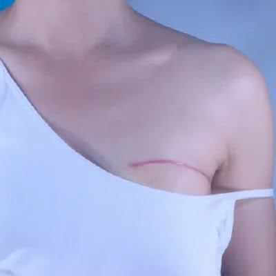 Breast Reconstruction in Islamabad