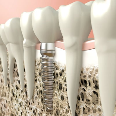 Can a Failed Dental Implant be Removed?