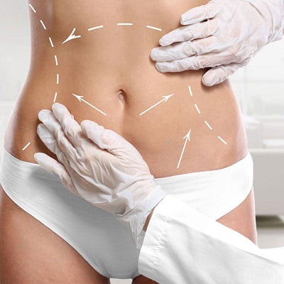 Does liposuction Impact Fertility?