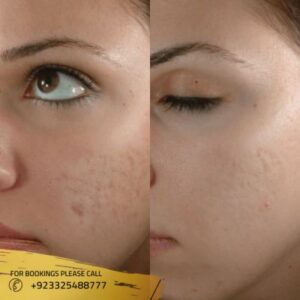 Fractional Co2 Laser Scar before after results