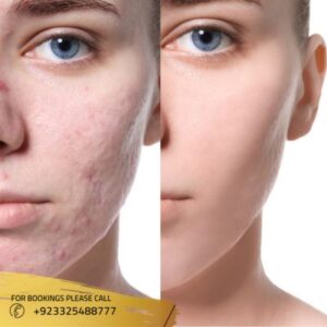 Fractional Co2 Laser Scar in Islamabad (1)