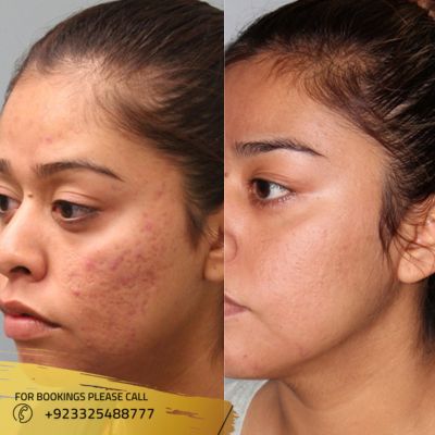 Fractional Co2 Laser Scar in Islamabad