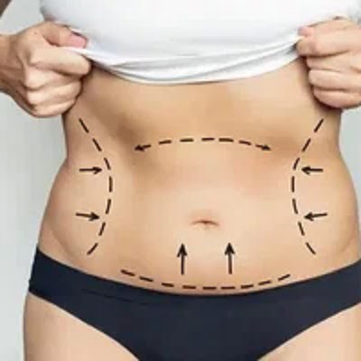 Liposuction Aftercare and Self-Care