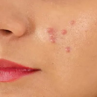 Why Does Glutathione Cause Acne Breakouts?