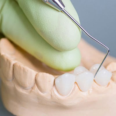 Will Teeth Whitening Work on Crowns or Bridges?