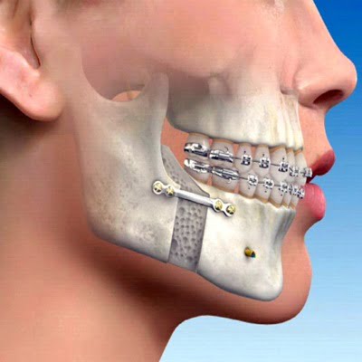 Does oral and maxillofacial surgery hurt?