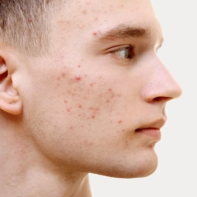 What is the Hardest Acne Scar to Remove?