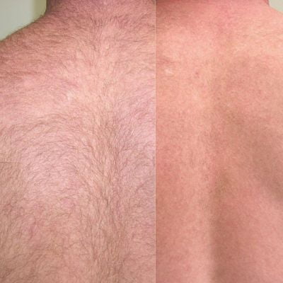 Can Laser Hair Removal Reduce Back Acne?