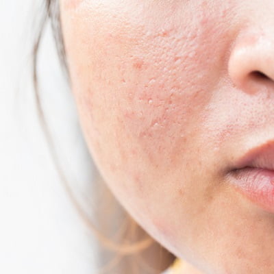 Can Plastic Surgery Reduce Acne Scars