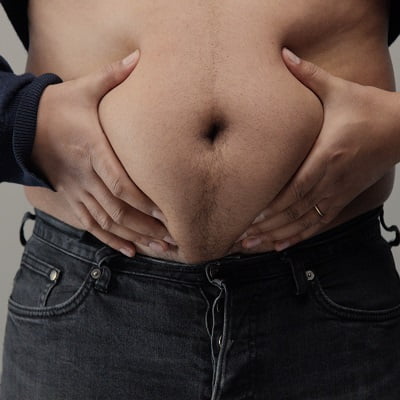 How Long Does Dumping Syndrome Last After Bariatric Surgery?