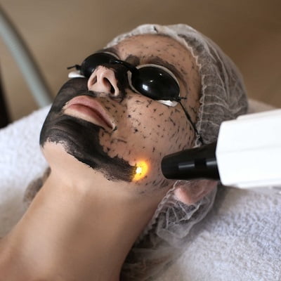 Which Is Better, Carbon Laser or Chemical Peel?