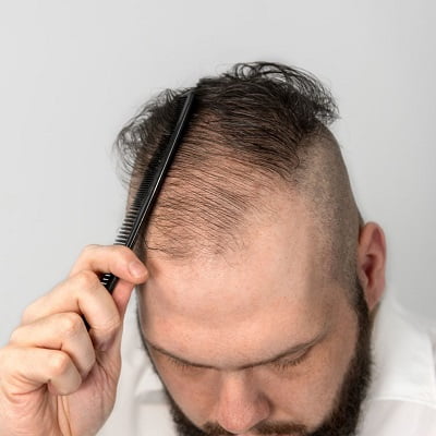 Which Therapy is Best for Hair Loss in Islamabad?