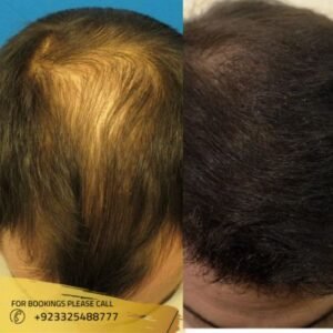 Best Doctors For Hair loss Treatment in Islamabad
