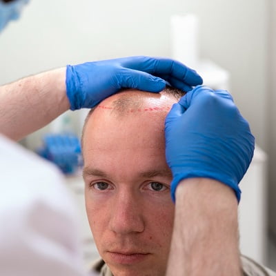 Does Hair Transplant Change Hair Texture and Color