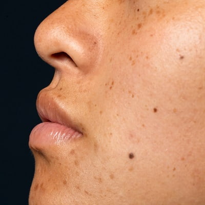 Does Laser Mole Removal Change Skin Texture