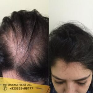 Hair loss treatment results in islamabad, Pakistan