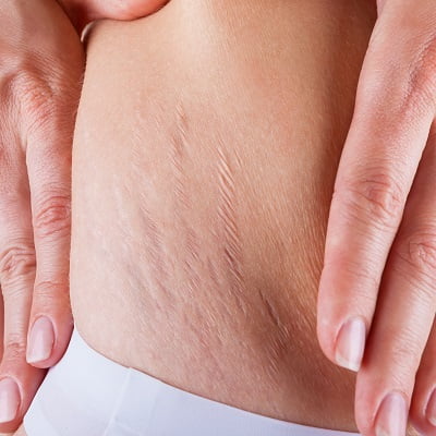 Find the significance of itchy stretch marks on your skin. Find out what causes them, how important they are, and how to prevent and treat them.