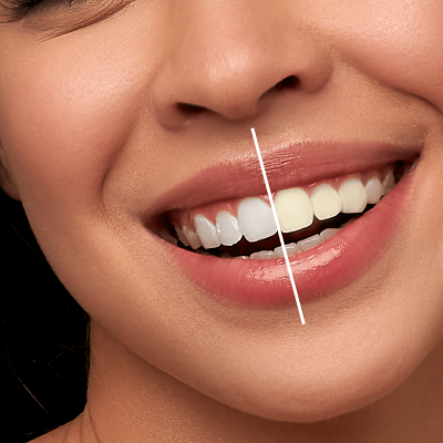 Does teeth whitening work on damaged teeth?